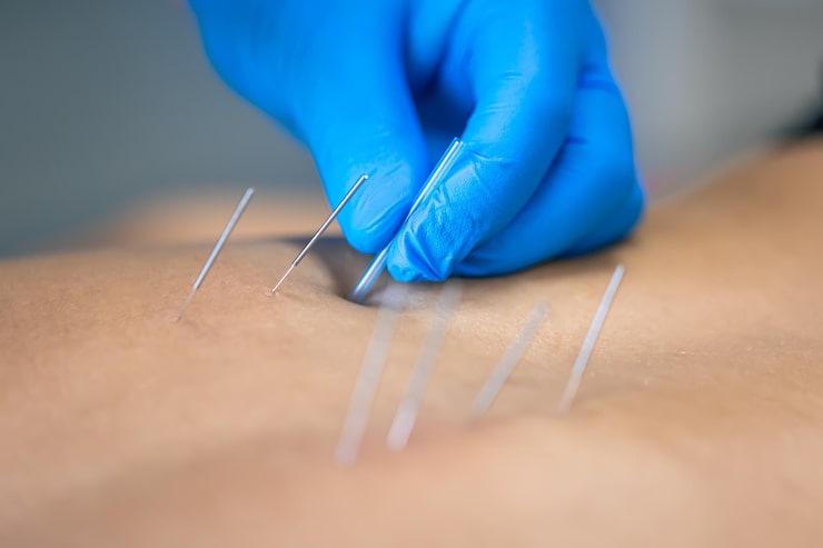 Close-up photograph of acupuncture needles placed along a patient's torso or abdomen — calm clinical setting with warm natural lighting, sage and cream tones